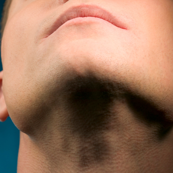 Upper Lip & Chin Laser Hair Removal
